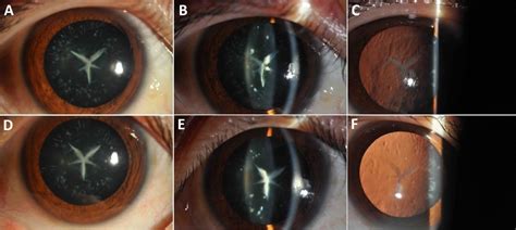 A Novel Mipgene Mutation Associated With Autosomal Dominant Congenital Cataracts In A Chinese