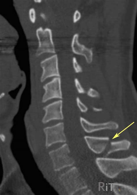Clay Shoveler Fracture Cervical Spinous Process Fractures Spine