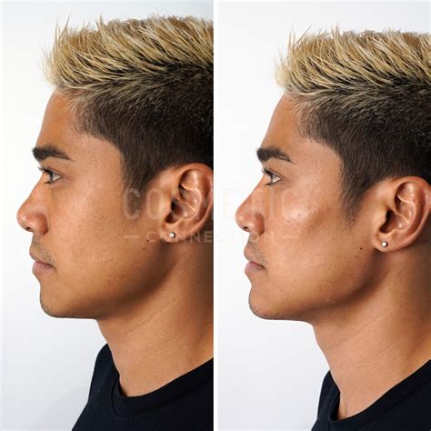 Men S Jawline Filler Cosmetic Connection