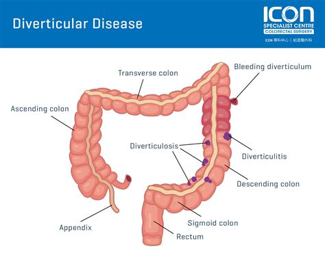 Diverticular Disease — Icon Specialist Centre