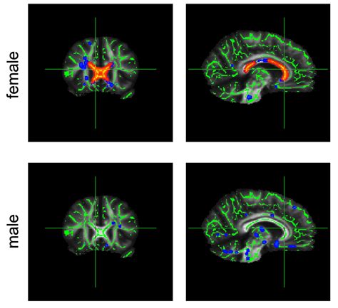Effects Of Obesity On The Brain First Evidence Of Sex Related Differences