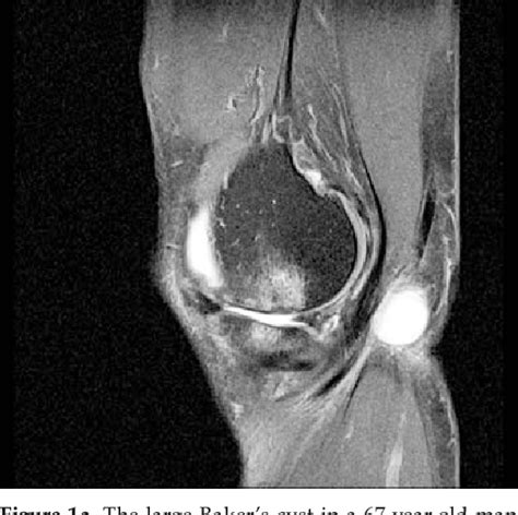 Figure 1 From Mri Diagnosis Of Baker Cyst And Significance Of