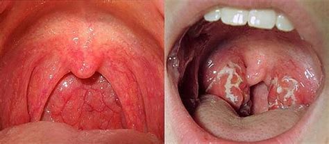 10 Warning Signs Of Throat Cancer You Should Not Ignore My Wordpress