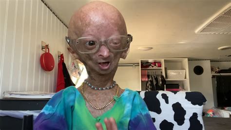 Youtube Star Adalia Rose Passes Away At 15 After Life With Rare Genetic Condition