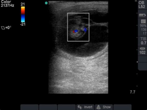 Ultrasonographic Image Of The Presumed Monozygotic Twins At Day 39