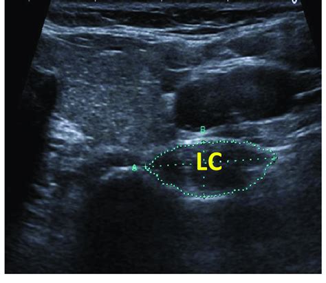 Ultrasound Image Of The M Longus Colli Lc M Longus Colli