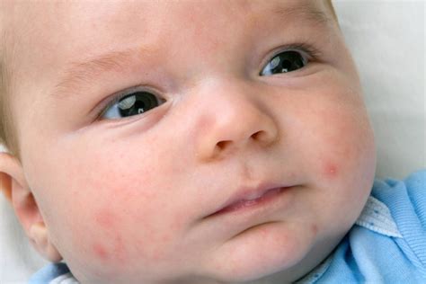 Common Baby And Toddler Rashes Babysparks
