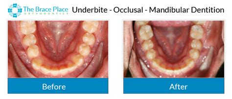 Occlusal Photo Of Mandibular Dentition The Brace Place Orthodontics