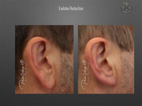 Earlobe Repair Archives Page 2 Of 2 New Orleans Premier Center For