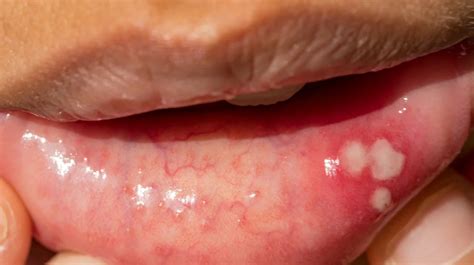 Mouth Sores Pictures Causes Types Symptoms And Treatments