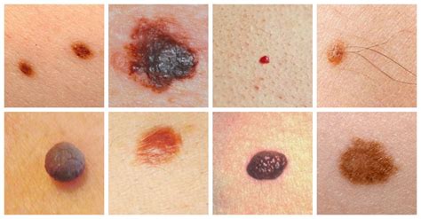 Is Your Mole Cancerous Detecting Skin Cancer With Dermoscopy