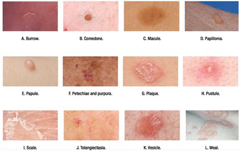 Primary Dermatological Lesions Primary Lesions Are Grepmed