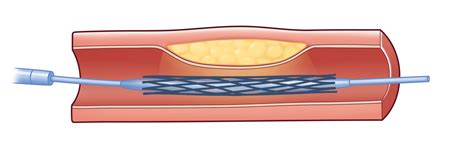 Longer Duration Of Dual Antiplatelet Therapy After Stent