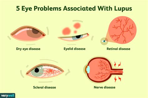 5 Ways Lupus Affects The Eyes