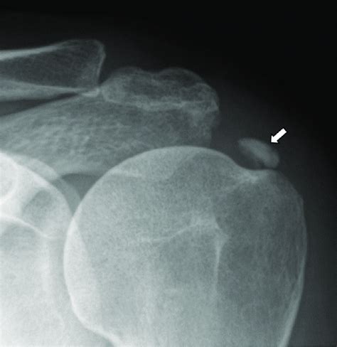 Calcific Tendinitis In Year Old Woman With Left Shoulder Pain Download Scientific Diagram