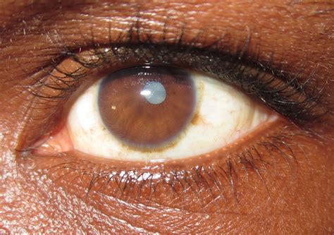 12 مرضاً تكشفهم عينيك بينهم البقع الوهمية واحمرار العين الرجل