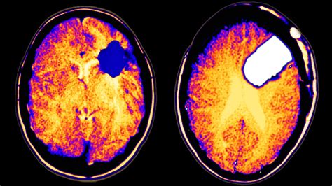 More Extensive Resection Of Low Grade Glioma Linked To Longer Survival