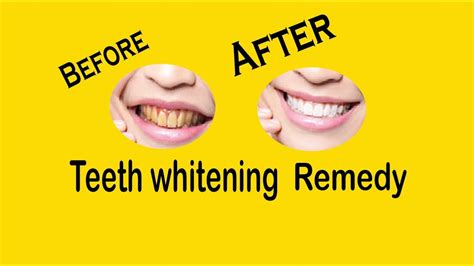 6 Simple Life Hacks For Teeth Whitening Everyone Should ...