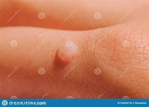 Common Wart At The Forehead Of Asian Myanmar Young Man It Is A Small