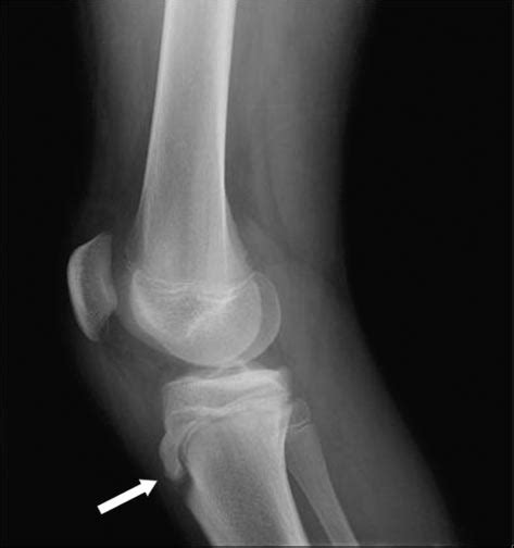 Lateral Radiograph Showing Partial Elevation Of The Tibial Tubercle