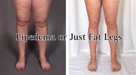 Lipedema Or Just Fat Legs Are You Overweight Have Lipedema