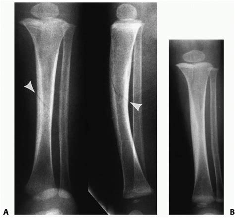 Fractures Of The Shaft Of The Tibia And Fibula Teachme Orthopedics