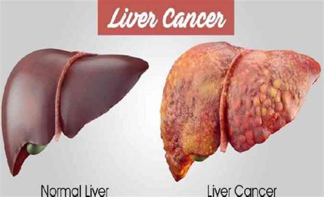 A fetal shunt that bypasses the lungs c. Liver cancer Treatment & Medicine In India - Ayurvedic ...