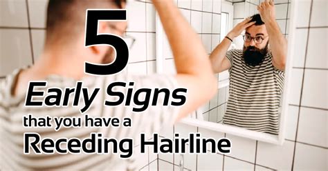 Receding Hairline Signs