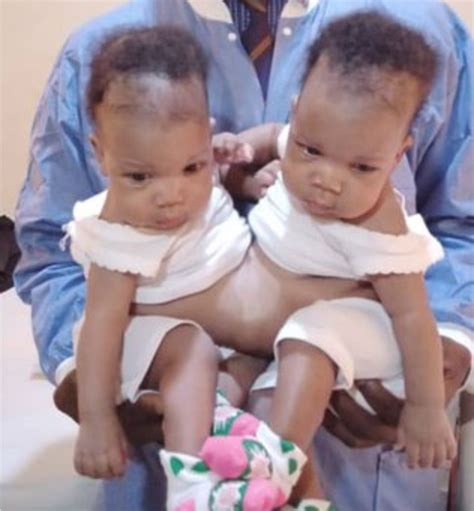 Conjoined twins separated at University of Ilorin Teaching ...