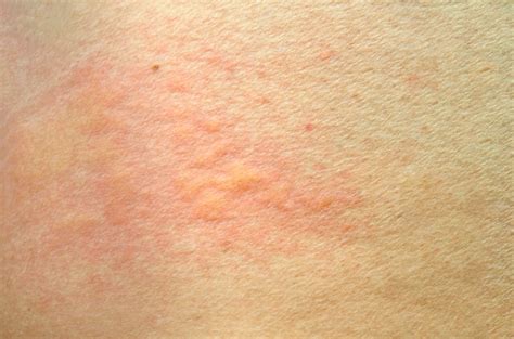 Premium Photo Skin Rash Urticaria Allergic Skin Reaction