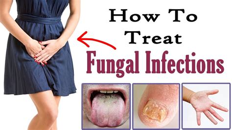 How To Treat Fungal Infection Naturally Home Remedies For Fungal Infection Treatment Youtube