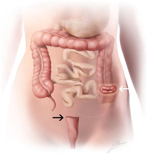 Illustration Of Hartmann Procedure A Sigmoidectomy Da