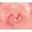 Swollen Uvula  Pictures Causes Symptoms Remedies Treatment
