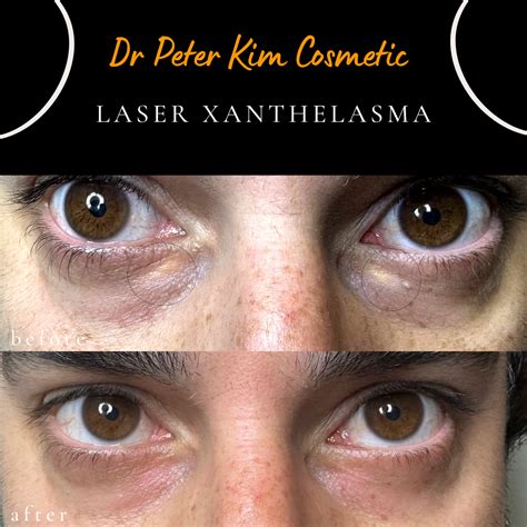 Laser Xanthelasma Removal Dr Peter Kim Surgery Skin Cancer