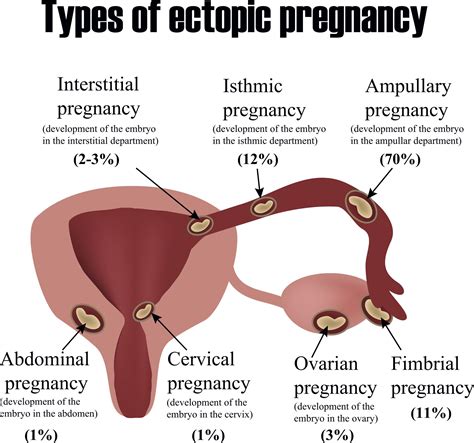 Ectopic Pregnancy Causes And Symptoms Symptoms Of Disease
