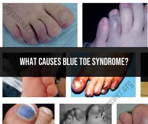 Blue Toe Syndrome Causes And Symptoms An Overview