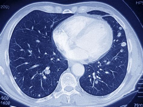 Oral scc carries a much worse prognosis. Medicare Poised To Cover CT Scans To Screen For Lung ...