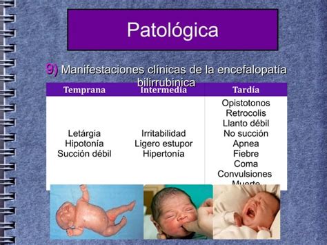 Ictericia Neonatal Por Hiperbilirubinemia No Conjugada