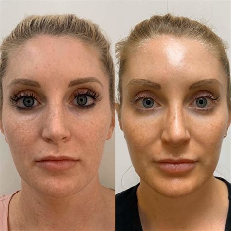 The Magic Of Prp Before And After Beauty Boost Med Spa