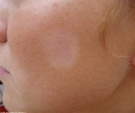 Pityriasis Alba Pictures Causes Symptoms Treatment White Skin
