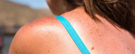 When To Seek Medical Treatment For A Severe Sunburn