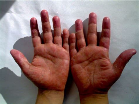 Palm Skin Rash Types Causes Pictures Treatment Health