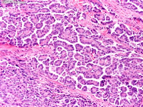 This is the most common cell type with the best prognosis. Webpathology.com: A Collection of Surgical Pathology Images