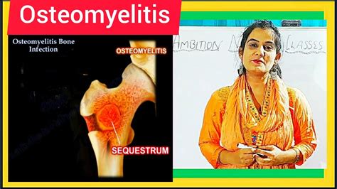 Osteomyelitis Causes Symptom Treatment Diagnosis Medical