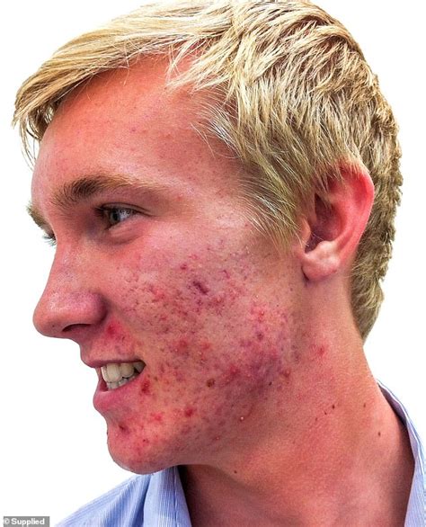 Actor 21 Reveals How He Cleared Up His Chronic Acne In Three Months
