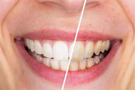 Dental Staining Problem Require A Dental Bleaching Treatment