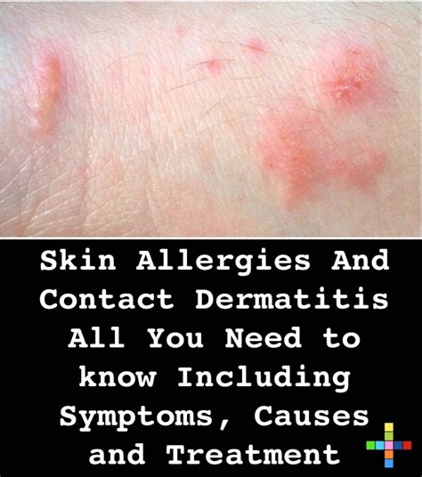 Skin Allergies And Contact Dermatitis All You Need To Know