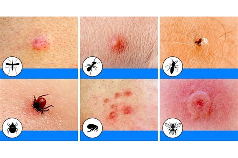 Chigger Bites Vs Bed Bug Bites