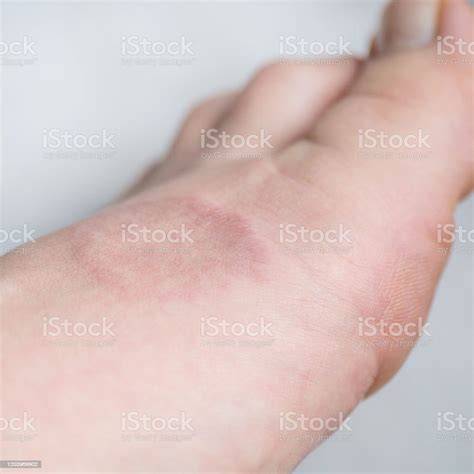 Human Leg With Granuloma Annular Or A Pink Lichen Skin Disease Stock