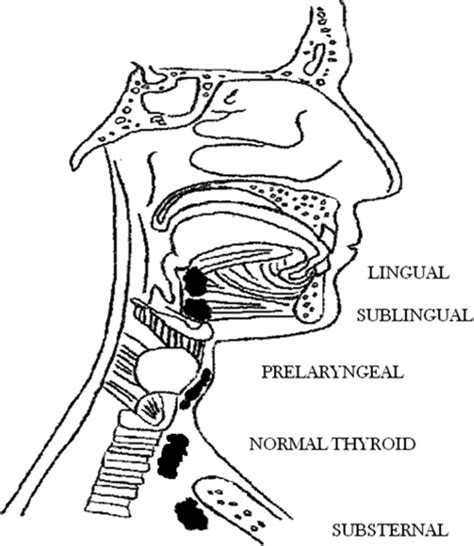 Ectopic Thyroid Tissue In The Head And Neck A Case Series Bmc